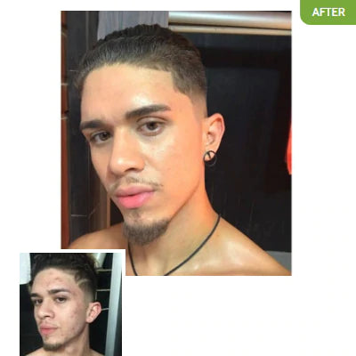 Before and after photos of Exposed Skincare results