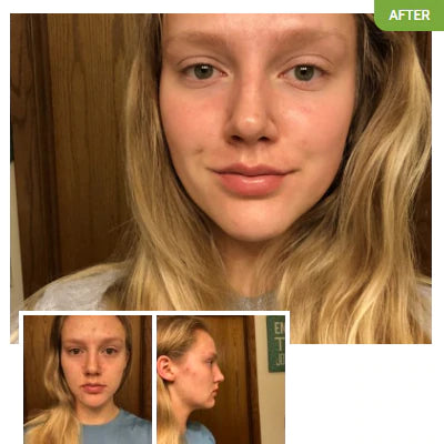 Before and after images of Exposed Skincare results