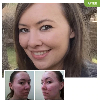 Woman with acne and without acne