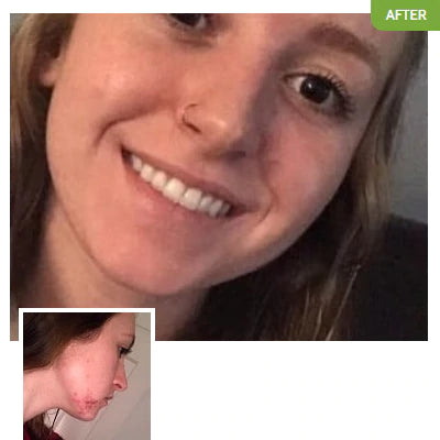 Before and after pictures of an Exposed Skincare customer