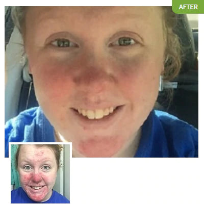 Before and after photos of an Exposed customer.