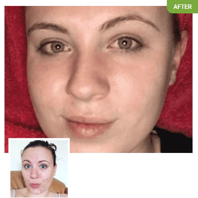 Before and after photos of an Exposed Skincare user