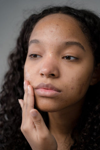 A woman with acne touches her face