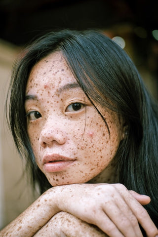 A young girl with freckles and a few pimples.