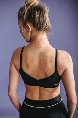 Woman with back acne.