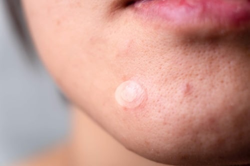 Close up of Pimple Patch on chin