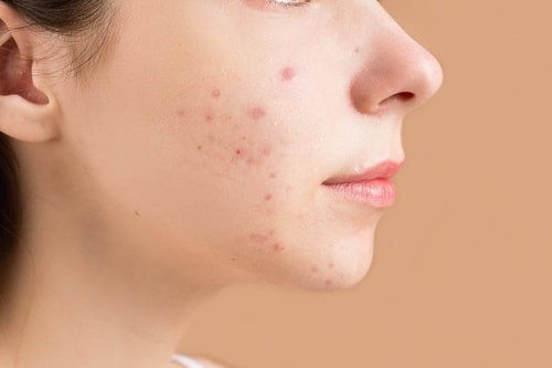 A face with acne under skin