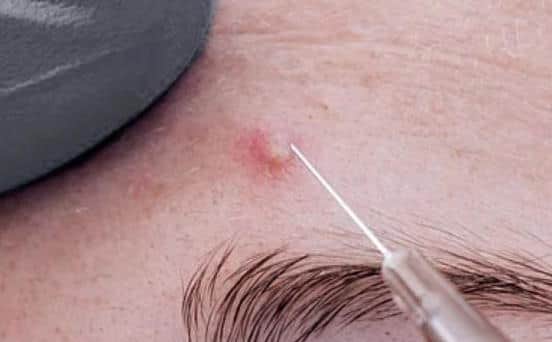 Cortisone injection in pimple.