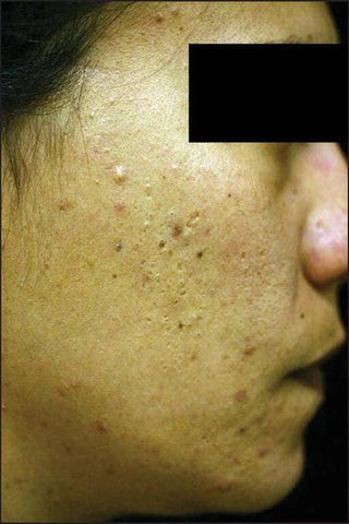 Woman with acne
