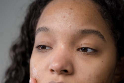 Girl worried about her acne between eyebrows