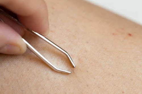 Tweezer removing ingrown hair