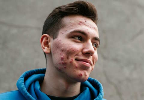 a young man with acne on face but smiling