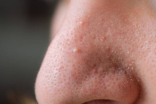 Close up image of clogged nose pores