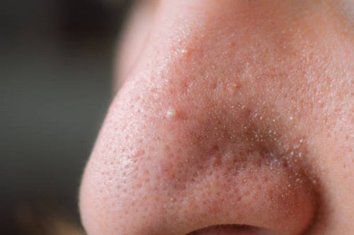 Close up of nose filled with white heads