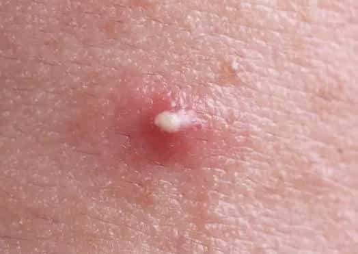 Pimple with white pus