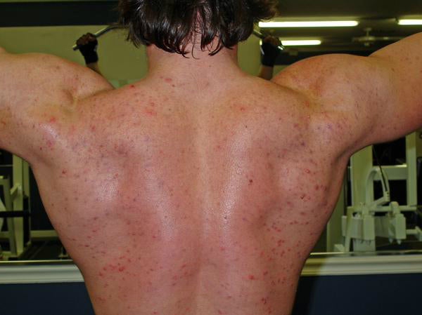 Steroid acne on muscular back of man.