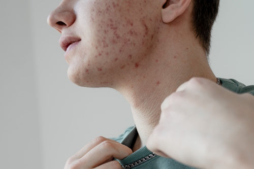 A guy in a turquoise sweater with acne on side of face