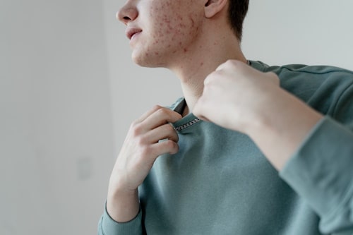 Young man with many pimples