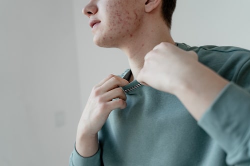 Young man with severe acne