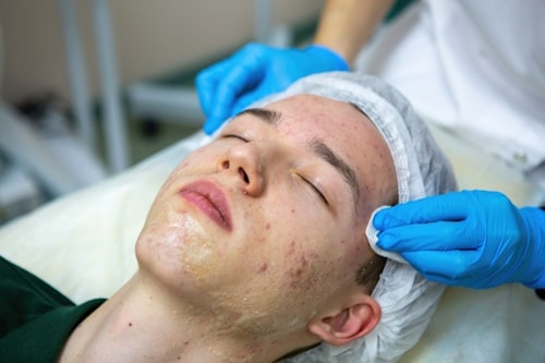 Boy with acne scars in a dermatologists clinic
