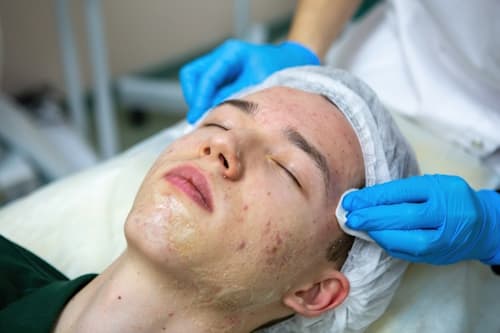Young man getting a facial for his acne
