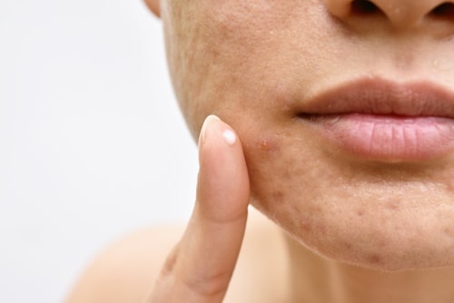 Woman applying topical antibiotics on her face