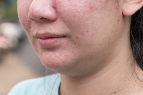 Woman going through skin purging after sulfur treatment