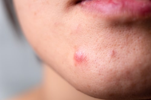 Close up of cystic acne on chin