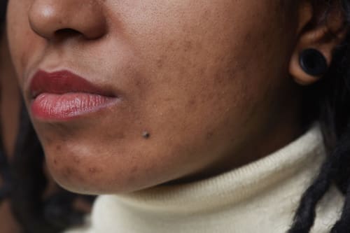 Dark skin tone woman with acne discoloration