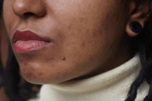 Woman with acne scars on her face