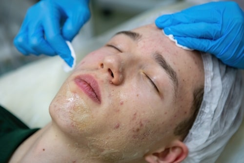 Man lying on bed with incredible acne