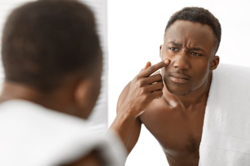 Man looking at mirror worried about acne