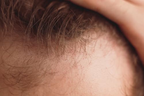 Forehead with hairloss