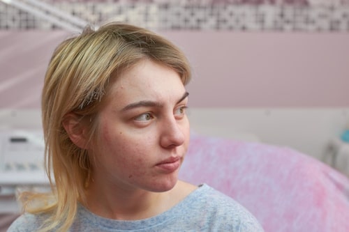 Young blonde woman with acne rosacea looking to the side