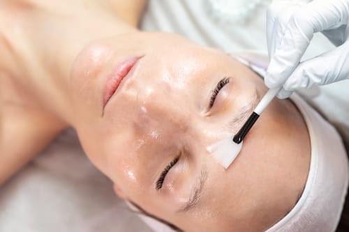 Chemical peel done on adult woman's face