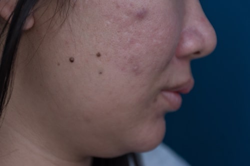 Face with acne