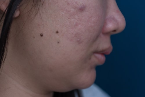 Acne bumps on woman's face