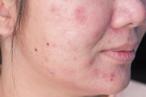 Close up of asian girl skin problem and acne on cheek 