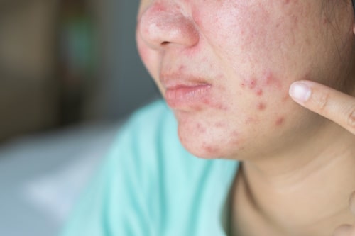 Woman with bacterial acne