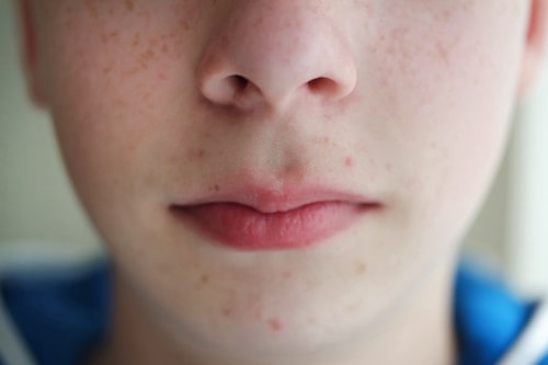 Close up of teen boys pimples