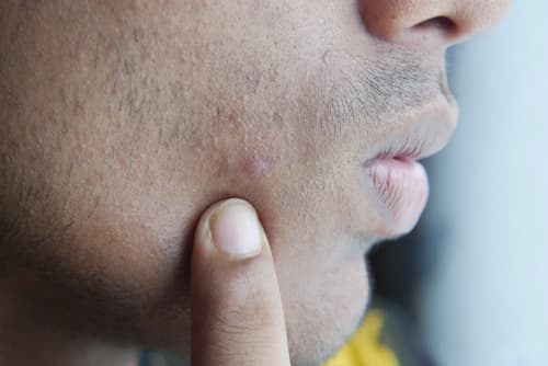 Person with facial hair and acne