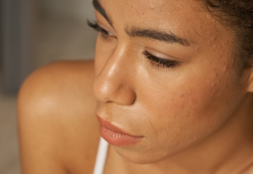 Close up portrait of young mixed race woman having acne