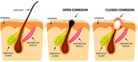 Comedoonal acne infographics