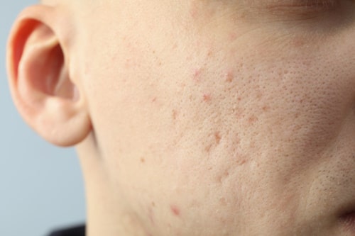 Young man with acne sccars on side of face