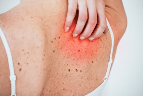 Reddish back skin due to laser