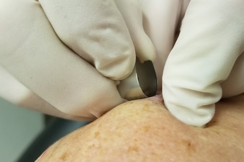 Skin biopsy being performed by trained dermatologist