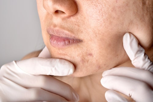 Face of woman suffering from acne scars