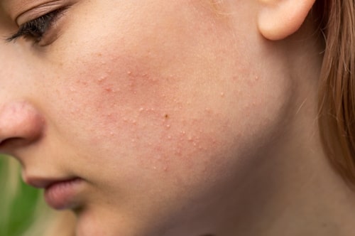Image of girl with clogged cheek pores