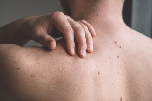 Man suffering from bacne or back acne