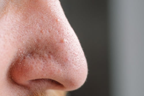 Close up of nose with acne